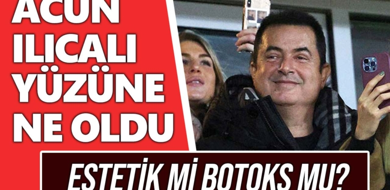 Acun Ilıcalı gözüne ne oldu? Acun Ilıcalı yüzü neden şiş? Acun estetik mi oldu?