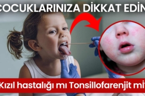 Kızıl-hastalığı-mı-Tonsillofarenjit-mi-çocuklarınıza-dikkat-edin-a24haber