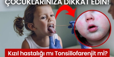 Kızıl-hastalığı-mı-Tonsillofarenjit-mi-çocuklarınıza-dikkat-edin-a24haber