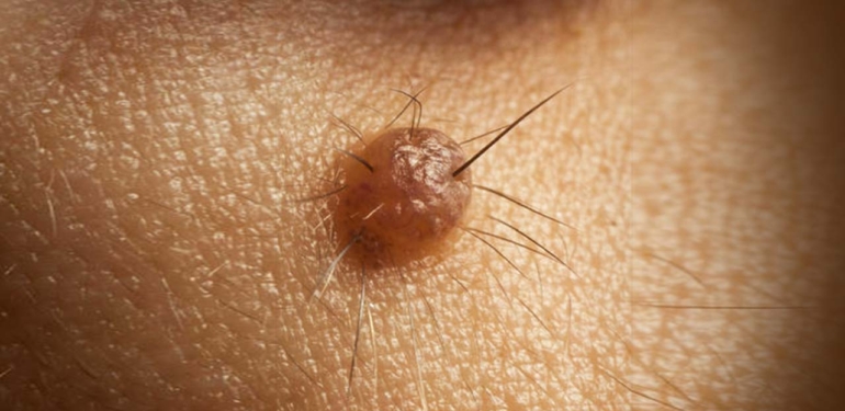 Saç dökülmesi tarihe karışacak! Bilim insanları keşfetti: Çare kıllı benlerde saklı